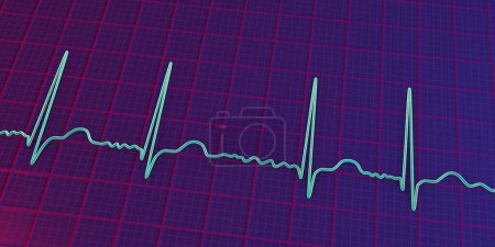 Photo for ECG in atrial fibrillation (AFib), a 3D illustration depicts irregular rhythm, absent P waves, and rapid, chaotic atrial activity, posing a risk of palpitations and stroke. - Royalty Free Image