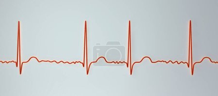 EKG bei Vorhofflimmern (AFib), eine 3D-Illustration stellt unregelmäßigen Rhythmus, fehlende P-Wellen und schnelle, chaotische Vorhofflimmern dar, die ein Risiko für Herzklopfen und Schlaganfall darstellen.