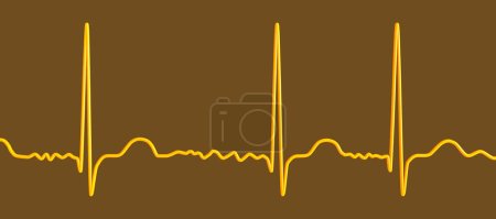 Foto de ECG en fibrilación auricular (AFib), una ilustración 3D muestra ritmo irregular, ausencia de ondas P y actividad auricular rápida y caótica, lo que representa un riesgo de palpitaciones y accidentes cerebrovasculares. - Imagen libre de derechos