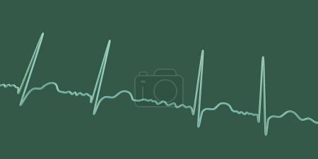 Foto de ECG en fibrilación auricular (AFib), una ilustración 3D muestra ritmo irregular, ausencia de ondas P y actividad auricular rápida y caótica, lo que representa un riesgo de palpitaciones y accidentes cerebrovasculares. - Imagen libre de derechos