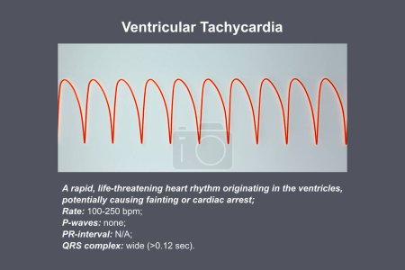 Photo for Ventricular tachycardia: A rapid heart rhythm originating in the ventricles, causes palpitations, dizziness, and life-threatening symptoms. ECG shows wide QRS complexes, 3D illustration. - Royalty Free Image