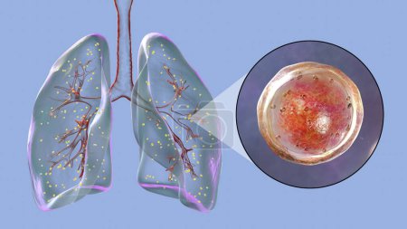 Foto de La adiaspiromicosis pulmonar, una rara infección respiratoria causada por el hongo Emmonsia spp., caracterizada por la presencia de esporas fúngicas encapsuladas agrandadas dentro de los tejidos pulmonares, ilustración 3D. - Imagen libre de derechos