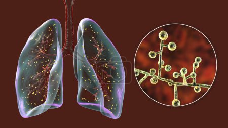Photo for Lung adiaspiromycosis, a rare respiratory infection caused by the fungus Emmonsia spp., characterized by the presence of enlarged encapsulated fungal spores within lung tissues, 3D illustration. - Royalty Free Image