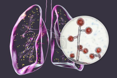 Foto de La adiaspiromicosis pulmonar, una rara infección respiratoria causada por el hongo Emmonsia spp., caracterizada por la presencia de esporas fúngicas encapsuladas agrandadas dentro de los tejidos pulmonares, ilustración 3D. - Imagen libre de derechos