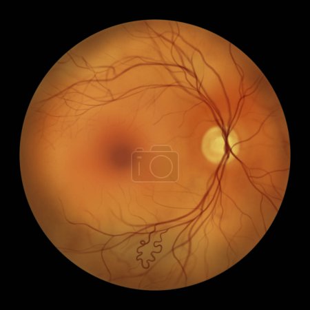 Malformación arteriovenosa retiniana: anomalías vasculares retinianas congénitas raras con vasos sanguíneos enredados en la retina, la ilustración muestra comunicación arteriovenosa sin capilares intervinientes.