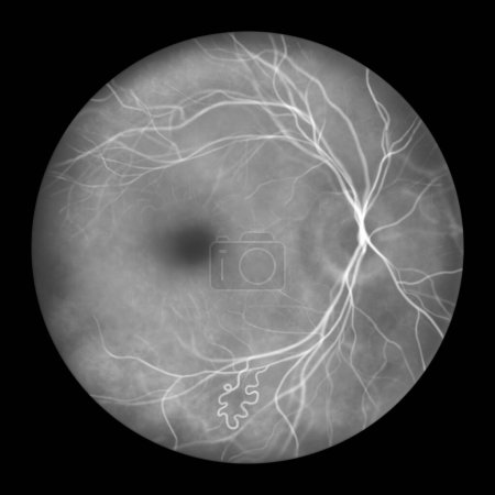 Foto de Malformación arteriovenosa retiniana, anomalías vasculares retinianas congénitas raras. Una ilustración muestra la comunicación arteriovenosa sin capilares intervinientes en la angiografía fluoresceínica. - Imagen libre de derechos