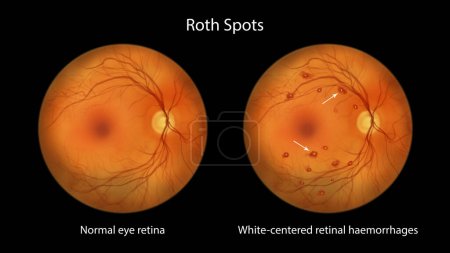 Foto de Manchas de Roth en la retina como se ve durante la oftalmoscopia, una ilustración que muestra hemorragias de retina centradas en el blanco con anillos hemorrágicos circundantes. - Imagen libre de derechos