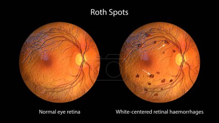 Manchas de Roth en la retina observadas durante la oftalmoscopia, una ilustración 3D que muestra hemorragias de retina centradas en el blanco con anillos hemorrágicos circundantes.