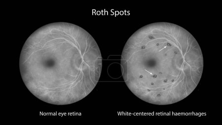 Foto de Manchas de Roth en la retina como se ve durante la oftalmoscopia en el angiograma con fluoresceína, una ilustración que muestra hemorragias de retina centradas en el blanco con anillos hemorrágicos circundantes. - Imagen libre de derechos