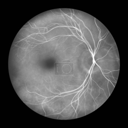 Foto de Retina normal, ilustración de una imagen oftalmoscópica en angiografía fluoresceínica. - Imagen libre de derechos