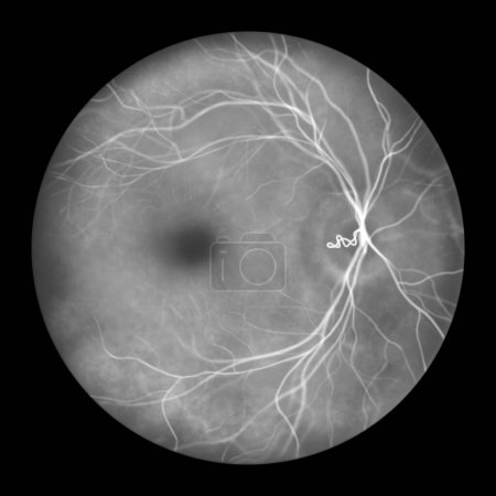 Téléchargez les photos : Une boucle vasculaire prépapillaire sur la rétine, comme observé lors de l'ophtalmoscopie en angiographie à fluorescéine, une illustration montrant les vaisseaux sanguins en boucle autour du disque optique. - en image libre de droit