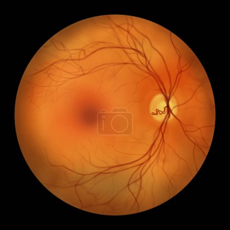 Photo for A prepapillary vascular loop on the retina, as observed during ophthalmoscopy, an illustration showcasing the looping blood vessels around the optic disc. - Royalty Free Image