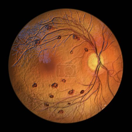 Foto de Manchas de Roth en la retina observadas durante la oftalmoscopia, una ilustración 3D que muestra hemorragias de retina centradas en el blanco con anillos hemorrágicos circundantes. - Imagen libre de derechos