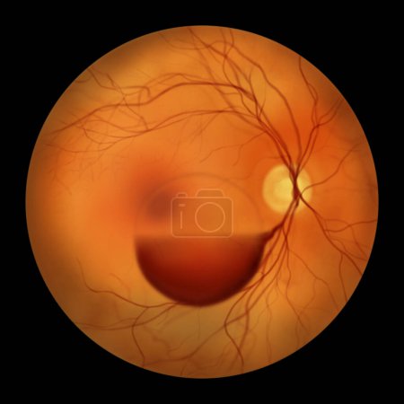 Photo for A subhyaloid hemorrhage on the retina as observed during ophthalmoscopy, an illustration showcasing a dark, dome-shaped hemorrhage beneath the hyaloid membrane. - Royalty Free Image