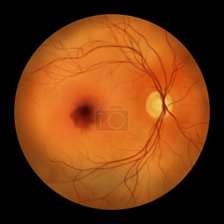 Photo for Medical illustration of a submacular hemorrhage observed during ophthalmoscopy, showcasing a dark, irregularly shaped hemorrhage within the macular region of the retina. - Royalty Free Image