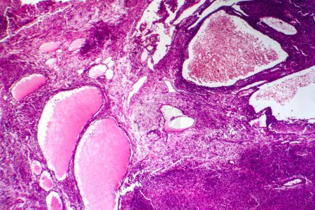 Foto de Fotomicrografía del fibrosarcoma, revelando fibroblastos malignos y tejido conjuntivo rico en colágeno, característico del cáncer de tejido blando agresivo. - Imagen libre de derechos
