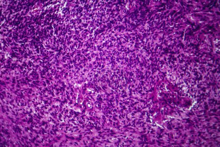 Téléchargez les photos : Photomicrographie du fibrosarcome, révélant des fibroblastes malins et du tissu conjonctif riche en collagène, caractéristique du cancer agressif des tissus mous. - en image libre de droit