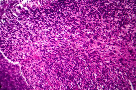 Téléchargez les photos : Photomicrographie du fibrosarcome, révélant des fibroblastes malins et du tissu conjonctif riche en collagène, caractéristique du cancer agressif des tissus mous. - en image libre de droit