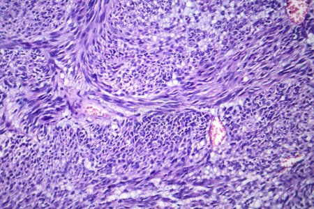 Téléchargez les photos : Photomicrographie du léiomyome, illustrant les cellules tumorales bénignes du muscle lisse dans le tissu utérin. - en image libre de droit
