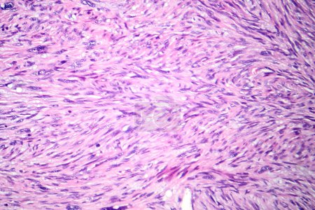 Téléchargez les photos : Photomicrographie du léiomyosarcome, représentant des cellules tumorales malignes du muscle lisse, indiquant un cancer agressif des tissus mous. - en image libre de droit