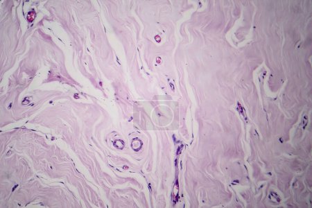 Photo for Photomicrograph of fibroadenoma, showcasing benign glandular and fibrous tissue growth within the breast, a common noncancerous tumor. - Royalty Free Image