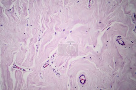 Téléchargez les photos : Photomicrographie du fibroadénome, montrant une croissance bénigne des tissus glandulaires et fibreux dans le sein, une tumeur non cancéreuse commune. - en image libre de droit