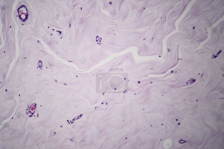 Photo for Photomicrograph of fibroadenoma, showcasing benign glandular and fibrous tissue growth within the breast, a common noncancerous tumor. - Royalty Free Image
