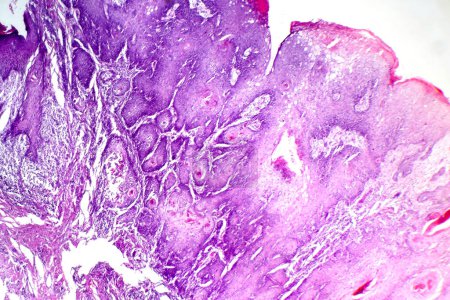 Foto de Fotomicrografía del carcinoma de células escamosas cutáneo, que representa células epidérmicas malignas, indicativo de un cáncer de piel común. - Imagen libre de derechos
