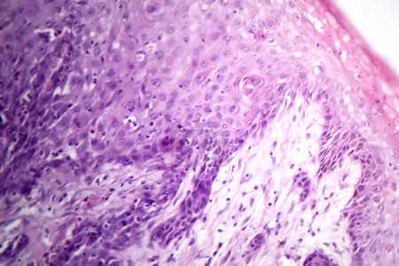 Téléchargez les photos : Photomicrographie du carcinome muqueux de l'estomac, montrant des cellules malignes productrices de mucine, caractéristique d'un cancer agressif de l'estomac. - en image libre de droit