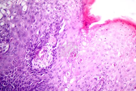 Téléchargez les photos : Photomicrographie du carcinome muqueux de l'estomac, montrant des cellules malignes productrices de mucine, caractéristique d'un cancer agressif de l'estomac. - en image libre de droit