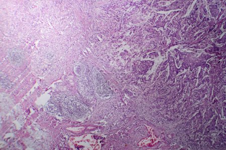 Photo for Photomicrograph of mucinous carcinoma in the stomach, displaying malignant mucin-producing cells, characteristic of an aggressive stomach cancer. - Royalty Free Image