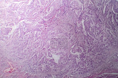Photo for Photomicrograph of mucinous carcinoma in the stomach, displaying malignant mucin-producing cells, characteristic of an aggressive stomach cancer. - Royalty Free Image
