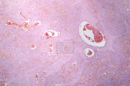 Photo for Photomicrograph of capillary hemangioma, illustrating abnormal proliferation of capillaries, characteristic of a benign vascular tumor. - Royalty Free Image