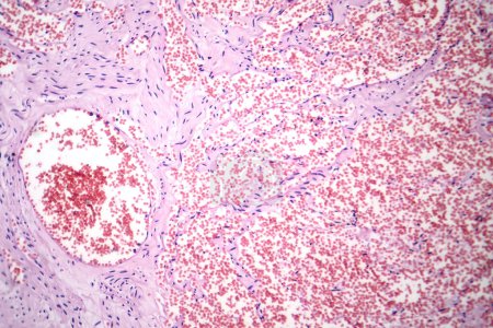 Foto de Fotomicrografía del hemangioma capilar, que ilustra la proliferación anormal de los capilares, característica de un tumor vascular benigno. - Imagen libre de derechos
