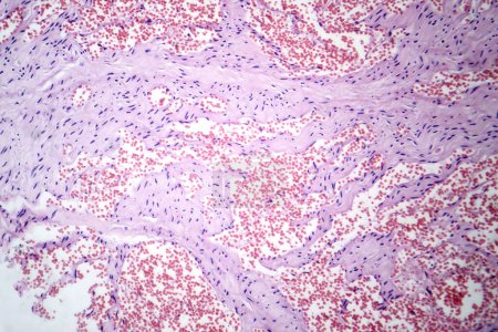 Foto de Fotomicrografía del hemangioma capilar, que ilustra la proliferación anormal de los capilares, característica de un tumor vascular benigno. - Imagen libre de derechos