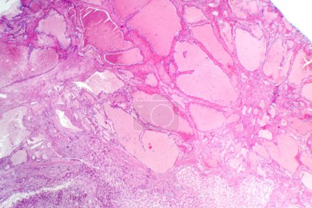 Photo for Photomicrograph of hepatic cavernous hemangioma, depicting dilated blood vessels in the liver tissue, characteristic of a benign tumor. - Royalty Free Image