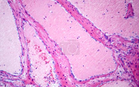 Foto de Fotomicrografía del hemangioma cavernoso hepático, que representa vasos sanguíneos dilatados en el tejido hepático, característica de un tumor benigno. - Imagen libre de derechos