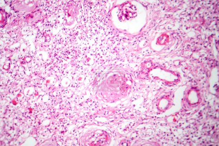Foto de Fotomicrografía del riñón contraído por partículas primarias, que ilustra tejido renal encogido y estructuras nefrónicas anormales. - Imagen libre de derechos