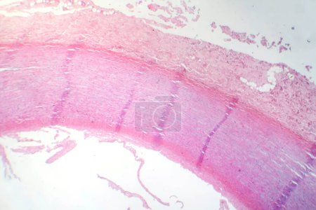 Téléchargez les photos : Photomicrographie de la nécrose fibrinoïde dans une paroi vasculaire, montrant une intégrité vasculaire endommagée et des changements liés à la réponse immunitaire. - en image libre de droit