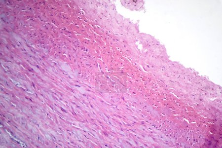 Foto de Fotomicrografía de necrosis fibrinoide en una pared vascular, mostrando integridad de los vasos dañados y cambios relacionados con la respuesta inmune. - Imagen libre de derechos