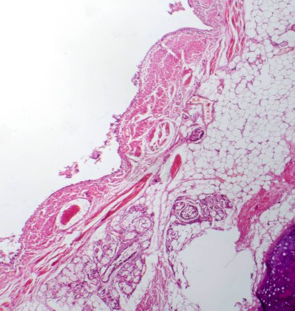 Foto de Fotomicrografía de bronquitis crónica, que muestra un revestimiento bronquial inflamado con exceso de producción de mucosidad, característica de la enfermedad de las vías respiratorias. - Imagen libre de derechos