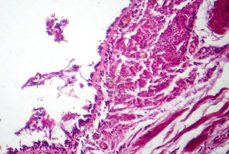 Foto de Fotomicrografía de bronquitis crónica, que muestra un revestimiento bronquial inflamado con exceso de producción de mucosidad, característica de la enfermedad de las vías respiratorias. - Imagen libre de derechos