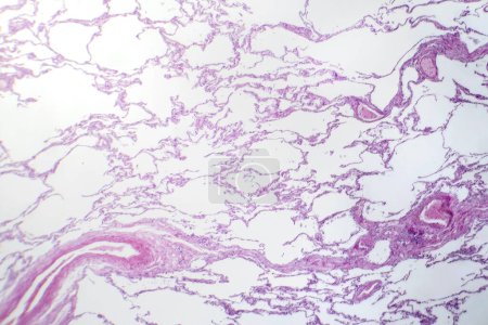 Foto de Fotomicrografía de enfisema difuso, revelando tejido pulmonar dañado con agrandamiento de los espacios aéreos, característica de la enfermedad pulmonar obstructiva crónica (EPOC). - Imagen libre de derechos