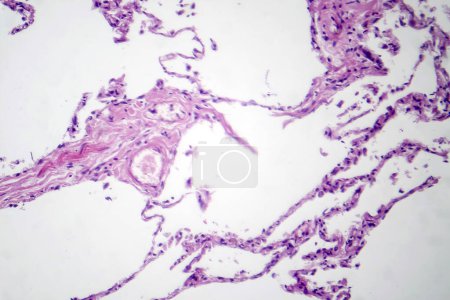 Photo for Photomicrograph of diffuse emphysema, revealing damaged lung tissue with enlarged airspaces, characteristic of chronic obstructive pulmonary disease (COPD). - Royalty Free Image