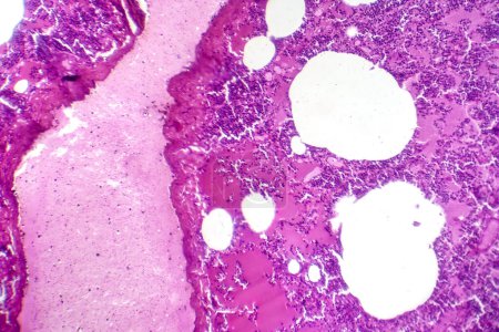 Foto de Fotomicrografía de neumonía lobar durante el período de edema hemorrágico, mostrando inflamación del tejido pulmonar con cambios hemorrágicos. - Imagen libre de derechos