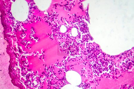 Photo for Photomicrograph of lobar pneumonia during the hemorrhagic edema period, displaying lung tissue inflammation with hemorrhagic changes. - Royalty Free Image