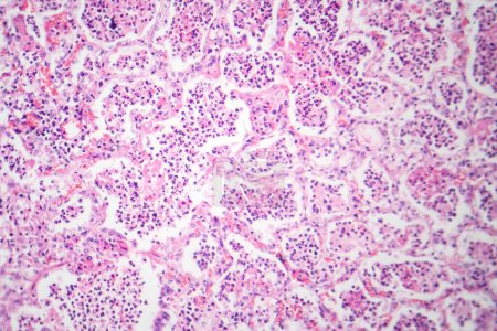 Photo for Photomicrograph of lobar pneumonia in red hepatic phase, displaying inflamed lung tissue with red hepatization characteristic of the disease. - Royalty Free Image