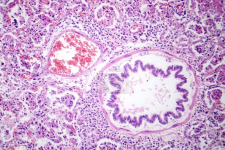 Téléchargez les photos : Photomicrographie de la pneumonie lobaire en phase hépatique rouge, montrant un tissu pulmonaire enflammé présentant une hépatation rouge caractéristique de la maladie. - en image libre de droit
