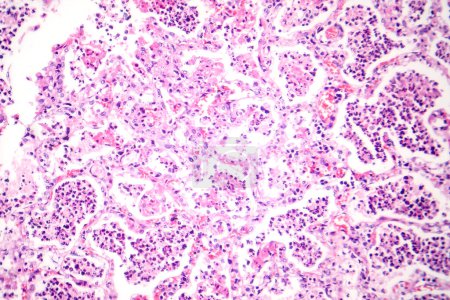 Photo for Photomicrograph of lobar pneumonia in red hepatic phase, displaying inflamed lung tissue with red hepatization characteristic of the disease. - Royalty Free Image