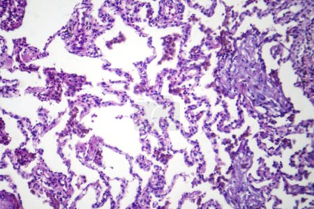 Photo for Photomicrograph of lobar pneumonia in dissolved dissipate period, showing resolving inflammation and clearing of lung tissue. - Royalty Free Image